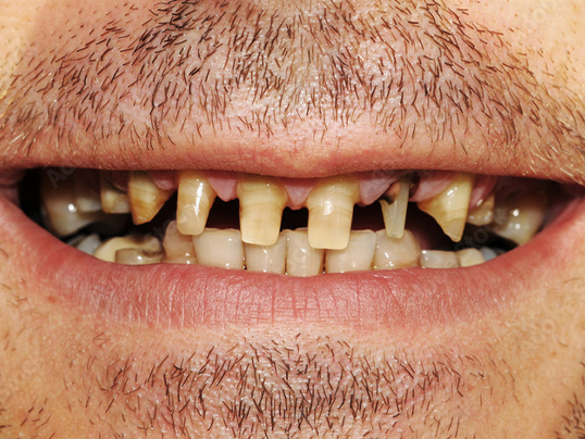 After dental veneers treatment at Adil Dent 