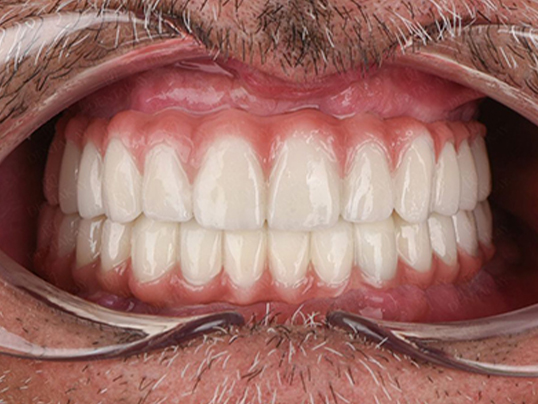 Before dental implants treatment at Adil Dent 