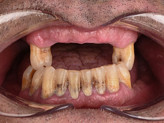 After dental implants treatment at Adil Dent 