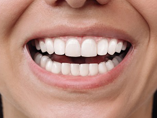 Before invisible aligners treatment at Adil Dent 