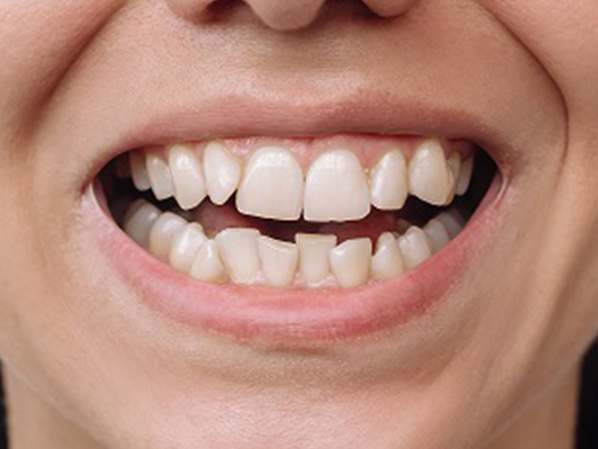 After invisible aligners treatment at Adil Dent 