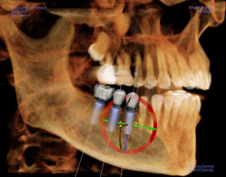 Dental Implants Surgery