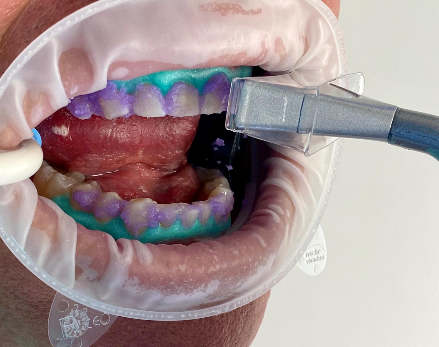 تبييض الليزر